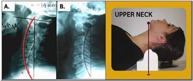 Cervical traction weight parameters picture